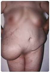 S�rv m�t�t el�tt. Epe m�t�t ut�ni hasfali s�rv (44 �ves n� beteg). 