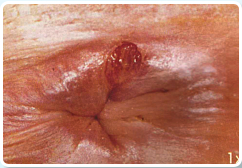 I. fok� an�lis fissura (akut v�gb�l reped�s)