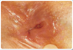 II. fok� an�lis fissura (kr�nikus v�gb�lreped�s, v�gb�lg�rcs)